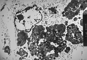 F,54y. | giant complex melanosomes … melanotic carcinosarcoma - uterus